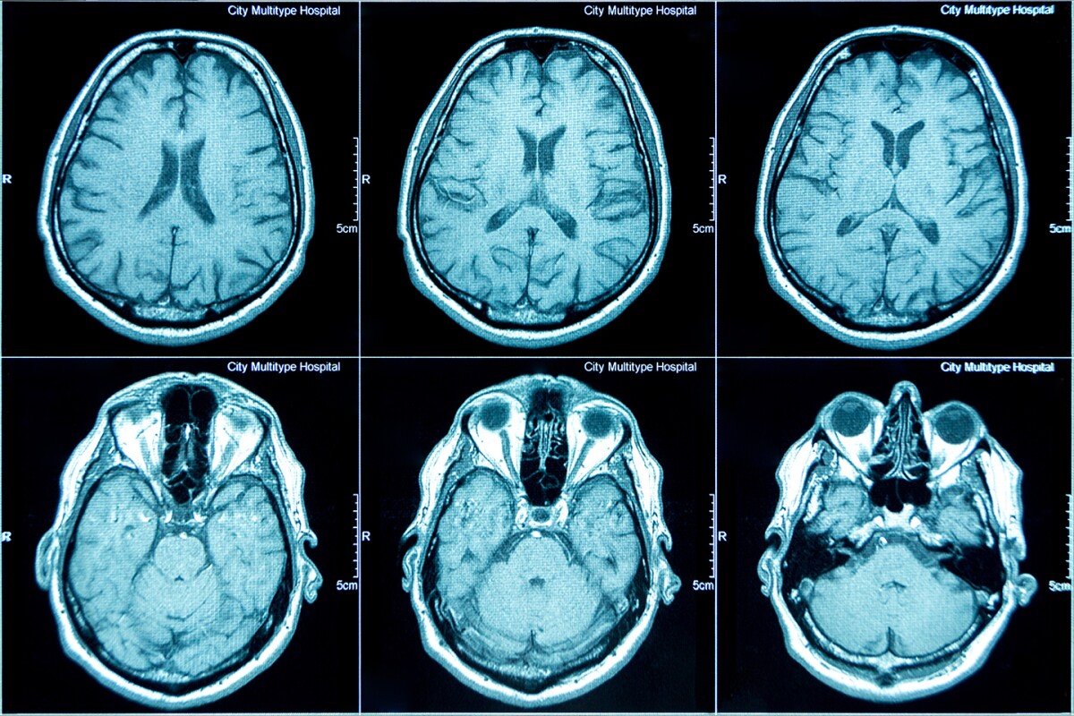 MRI scan stock image